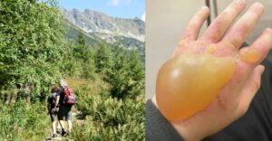 Po Slovensku sa šíri NAJNEBEZPEČNEJŠIA rastlina. Spôsobuje bublinové pľuzgiere, no bolesť najskôr nepocítiš hodiny
